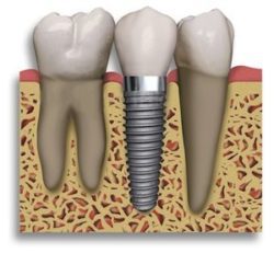 affordable dental implants in Lexington Kentucky