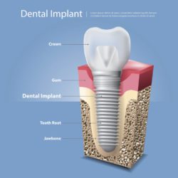 Replace Missing Teeth With Affordable Dental Implants in Lexington Kentucky