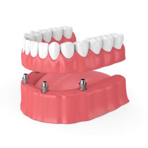 All-on-four implant secured dentures