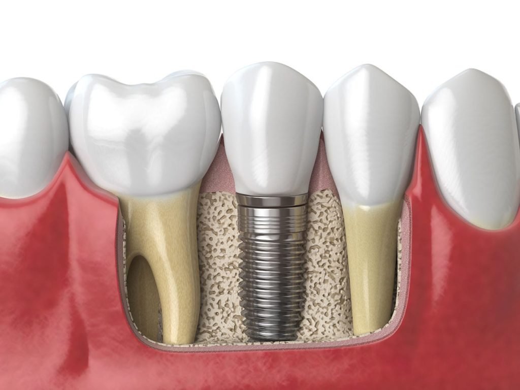 dental implant in Lexington Kentucky