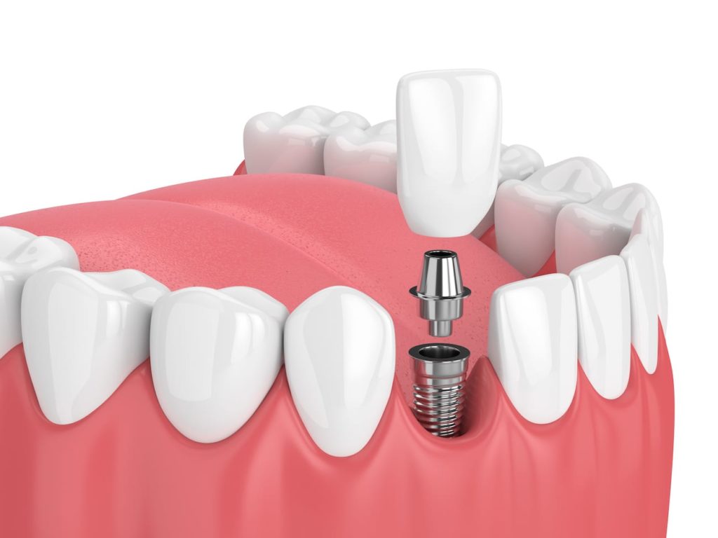 Dental implant post and abutment