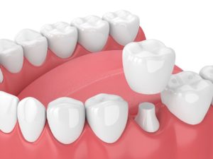 dental crown treatment in Lexington Kentucky
