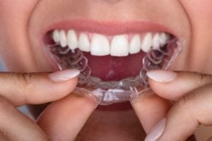 affordable Invisalign in Lexington Kentucky