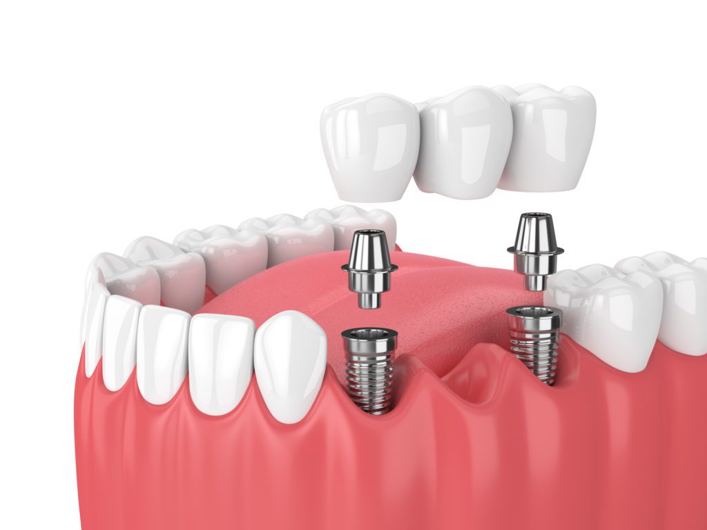 Dental Implant Bridge in Lexington, Kentucky at Complete Dentistry For All Ages