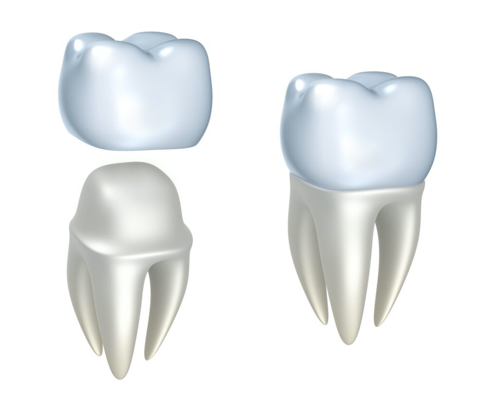 DENTAL CROWNS in LEXINGTON KY help preserve your natural tooth