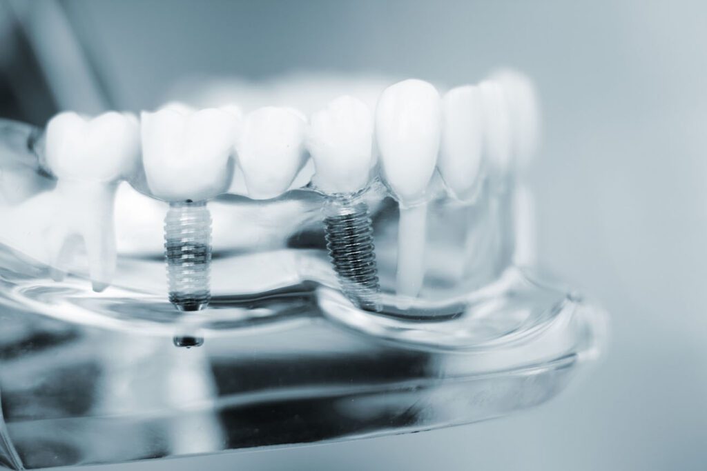 DENTAL IMPLANTS in LEXINGTON KY may require additional treatment before surgery