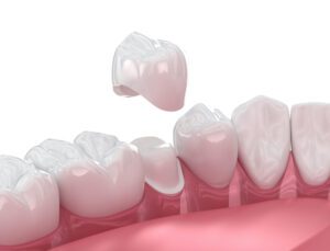 A dental crown treatment can fix many issues