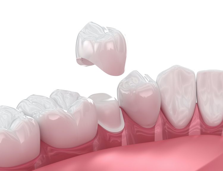 Understanding the process of getting a dental crown can ease patient anxiety and ensure a smooth treatment.