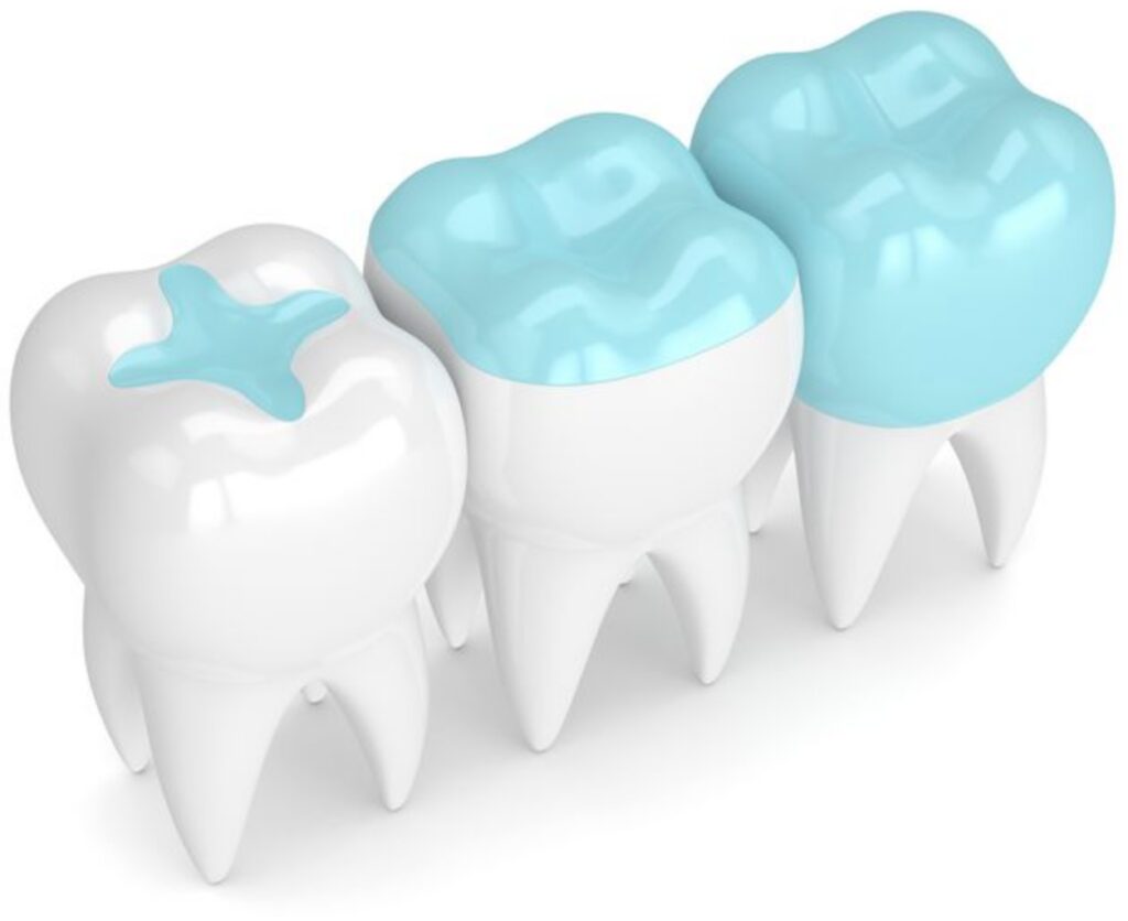 Dental bonding for damaged teeth