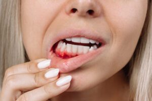 Treat bleeding gums before its too late