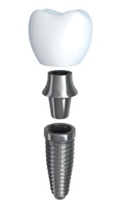 A dental implant treatment in Lexington